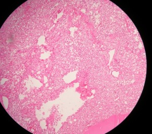 Renal Cell Carcinoma