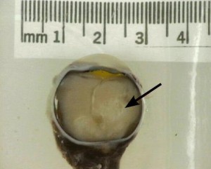 Retinoblastoma