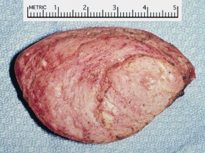 Rhabdomyoma