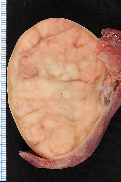 Seminoma Testes