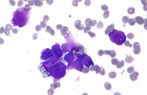 Small cell carcinoma