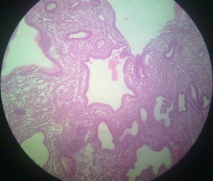 hyperplasia