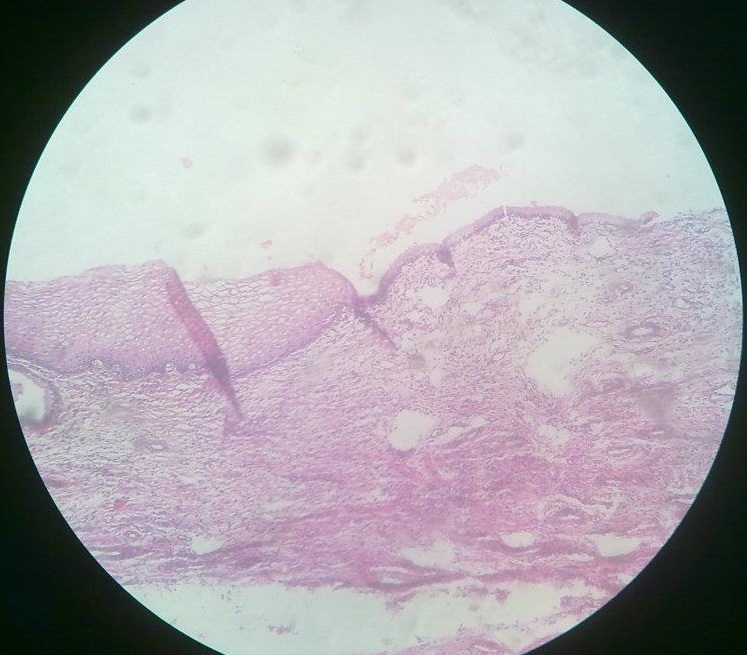 Cervical metaplasia